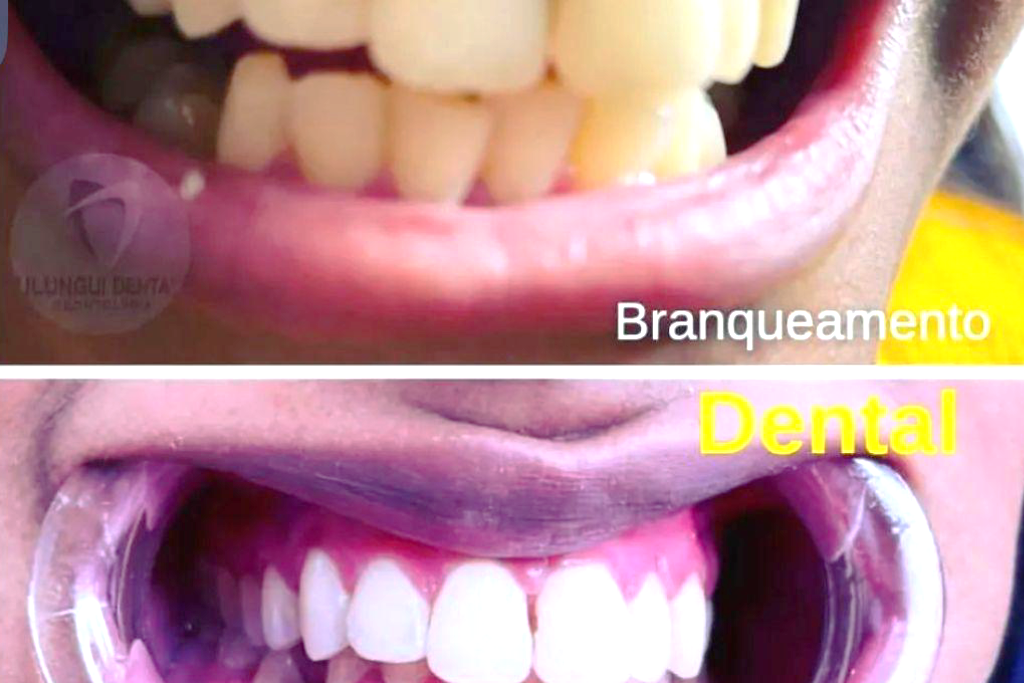 Extracao Odontologia